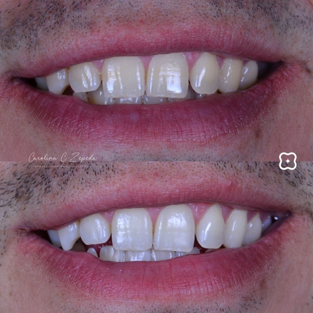 Caso - Blanqueamiento: antes y después 1