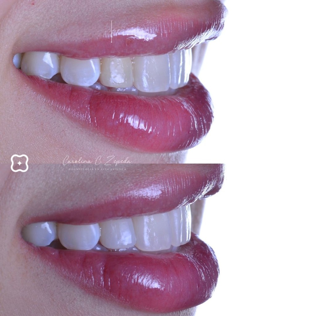 Caso - Blanqueamiento: antes y después 2