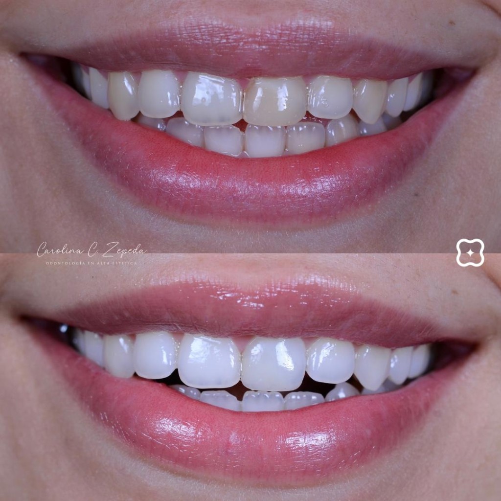 Caso - Blanqueamiento: antes y después 3