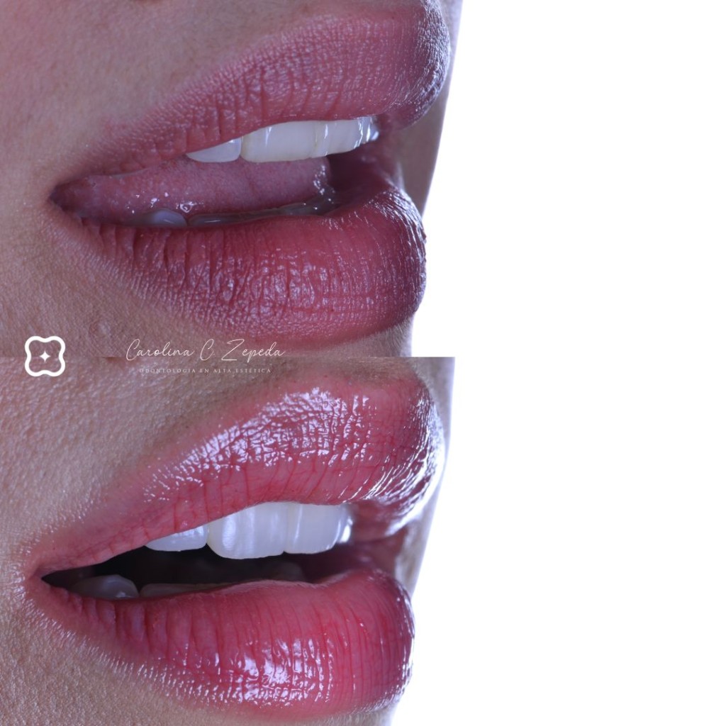 Caso - Carillas: antes y después 2