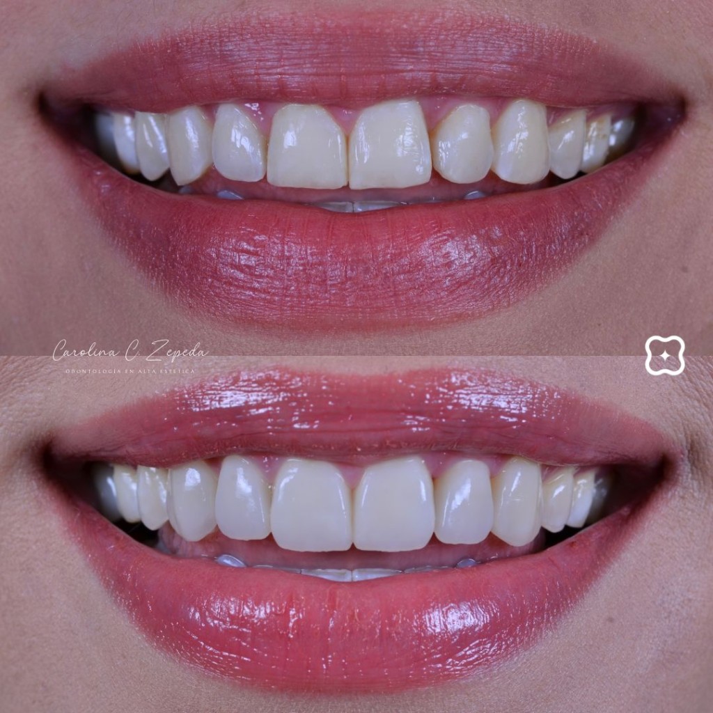 Caso - Carillas: antes y después 3