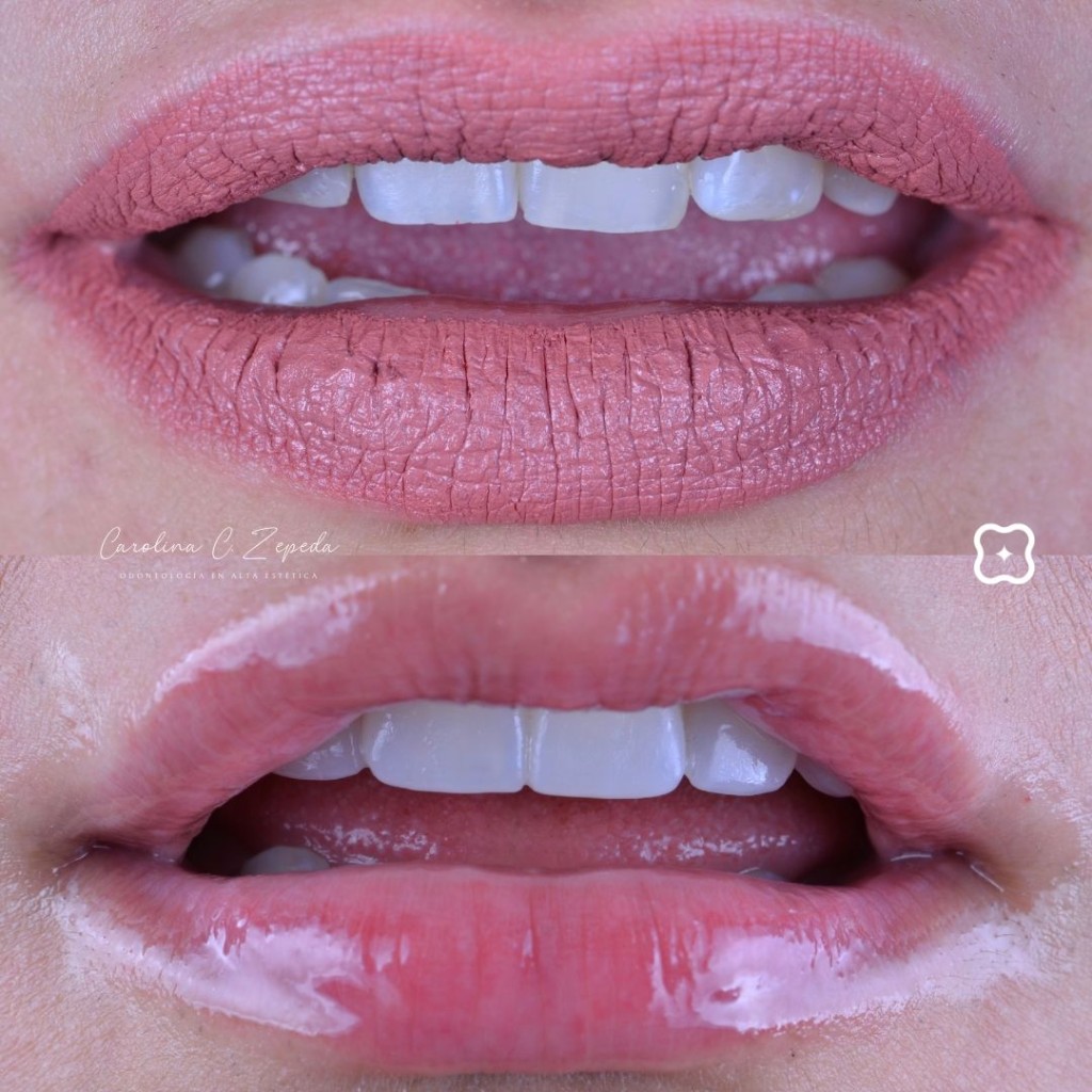 Caso - Carillas: antes y después 5