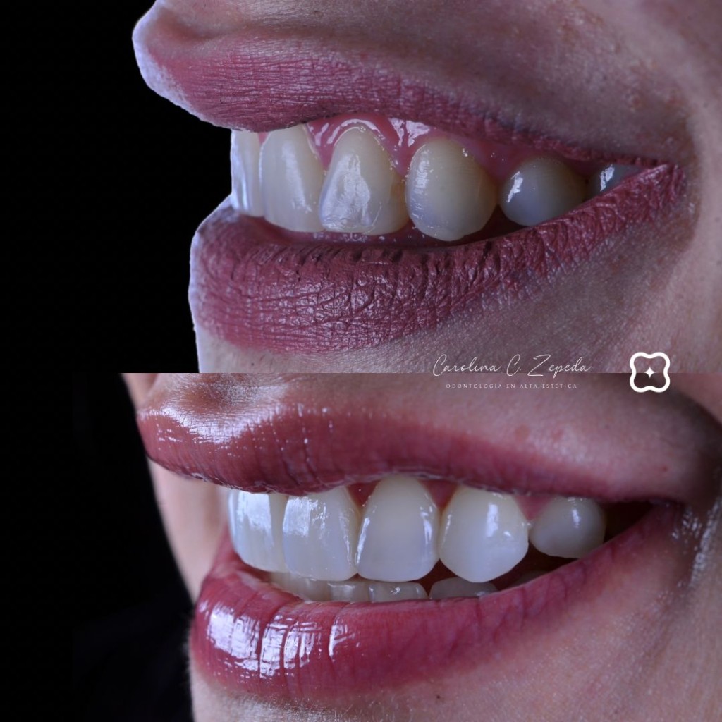 Caso - Carillas: antes y después 1