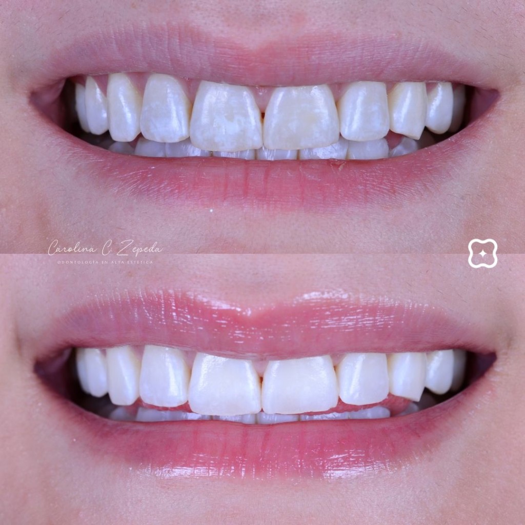 Caso - Microabrasión (eliminación manchas): antes y después